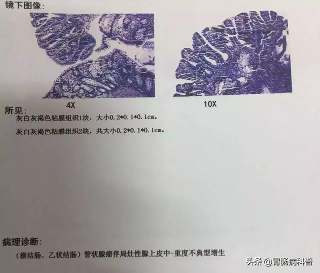 管狀腺瘤伴中-重度不典型增生.