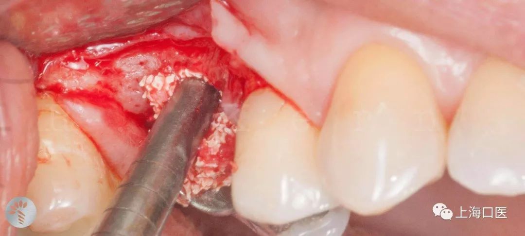 上頜竇區種植牙軟組織管理病例分享