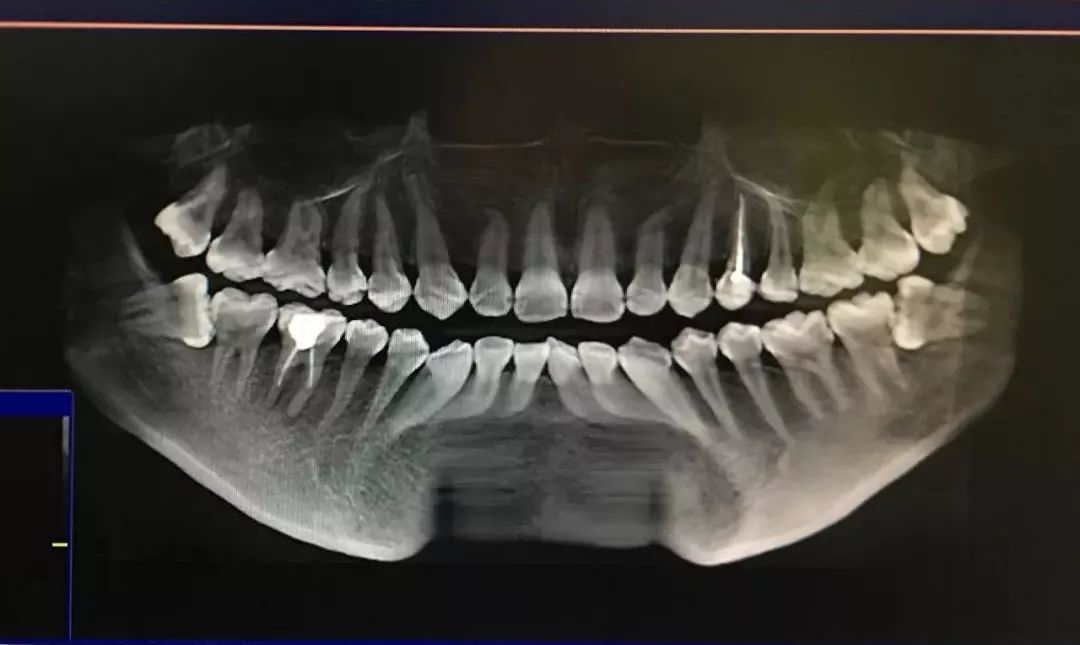 干货| 我的拔智齿经历及超详细术后护理心得
