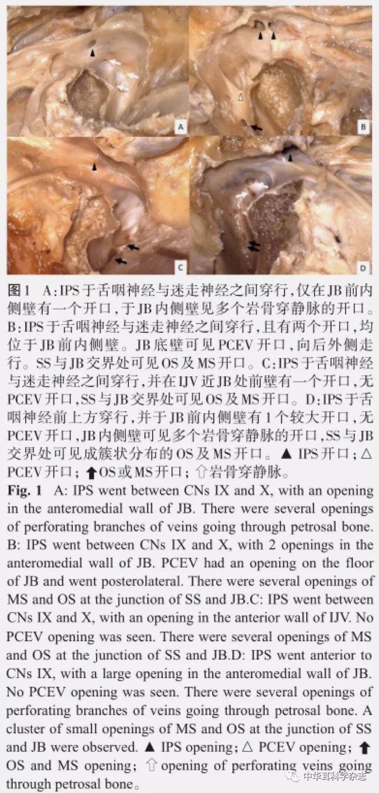 颈静脉孔区静脉窦开口的解剖学研究