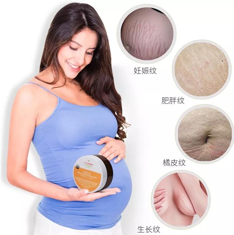 咱们孕期产前产后的妊娠纹,橘皮纹,生长纹,包括平时的肥胖纹都可以