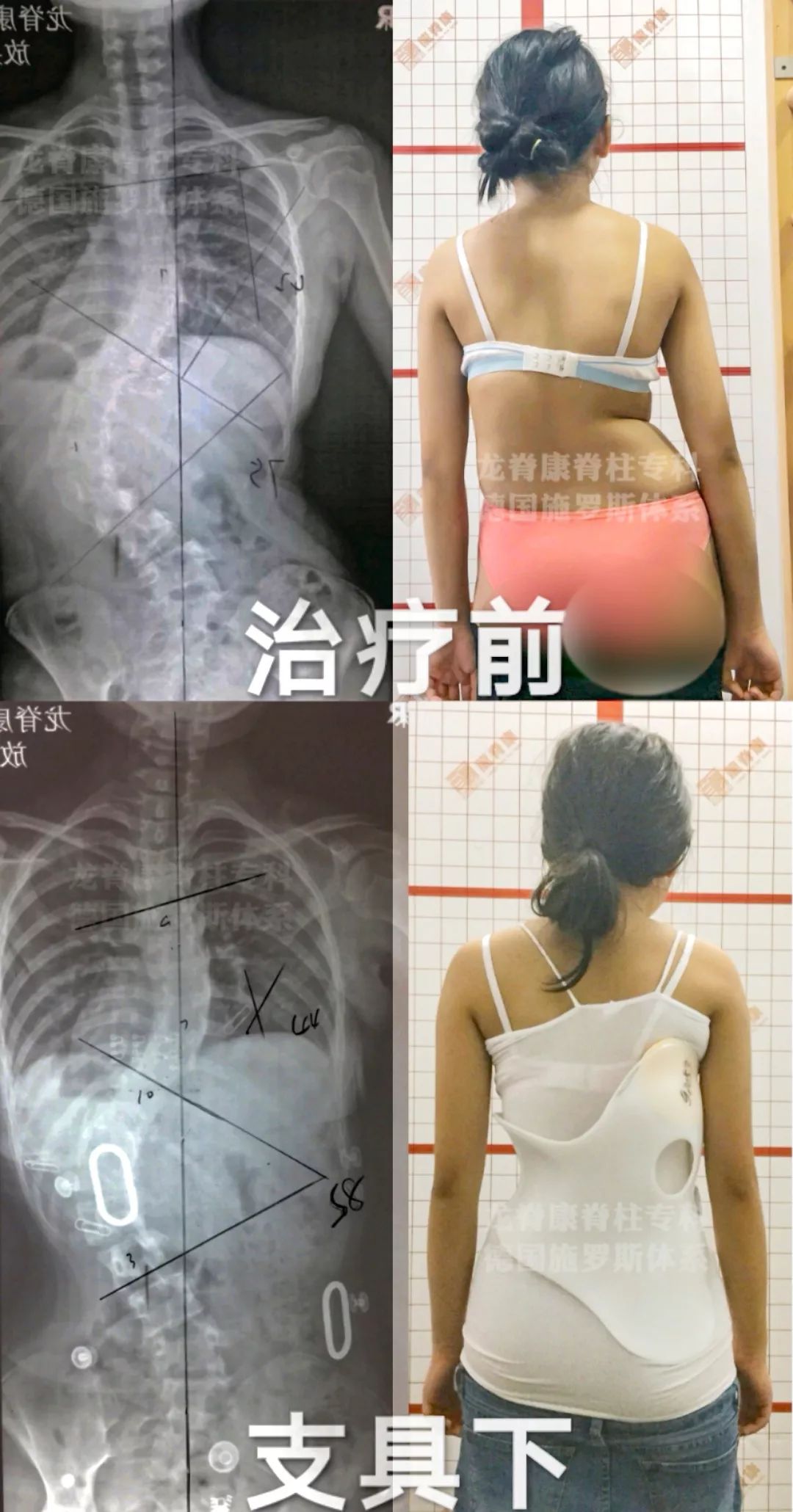 心痛14岁马来西亚脊柱侧弯女孩5年内从20恶化至75