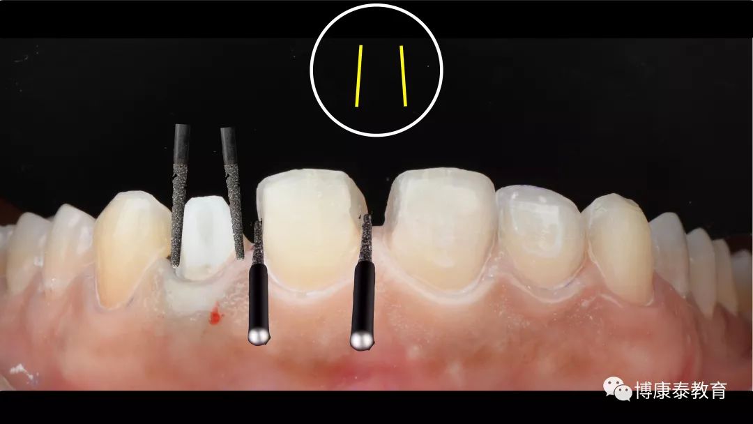 直播回看丨王戈老师:瓷贴面牙体预备方式的思考与讨论~_临床