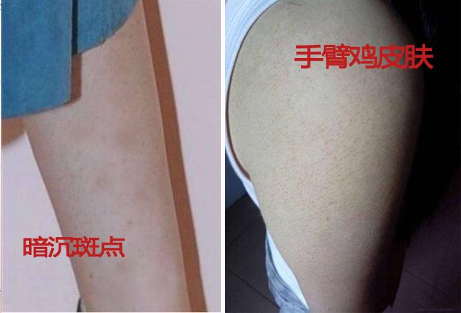 突然之间就有鸡皮肤(为什么会突然有鸡皮肤)