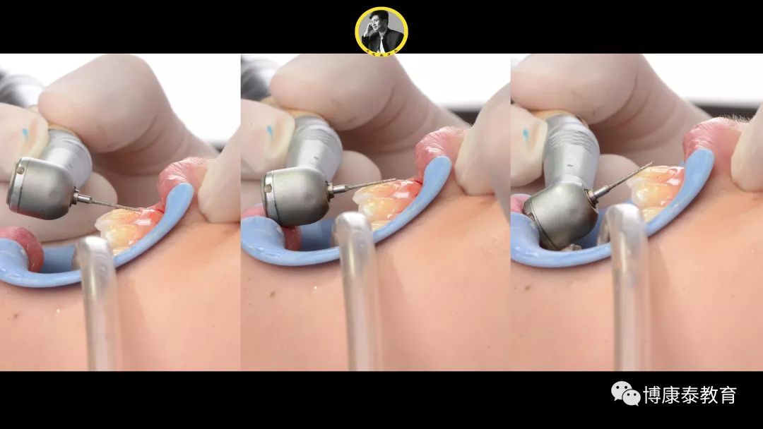 直播回看丨王戈老师:瓷贴面牙体预备方式的思考与讨论~_临床