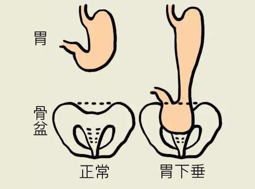 女性胃下垂的肚子图片图片