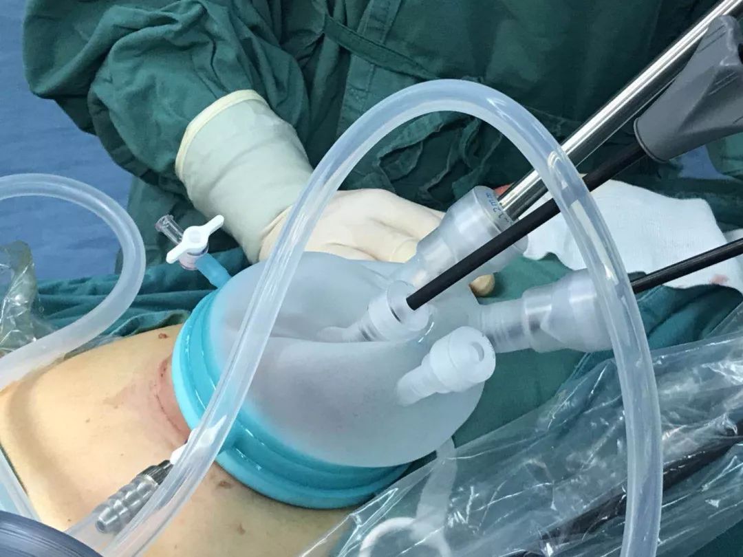 新技术单孔腹腔镜手术让你美丽不打折