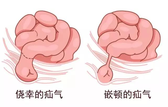 小儿疝气能不能不做手术吃药好不了吗专业医生告诉您