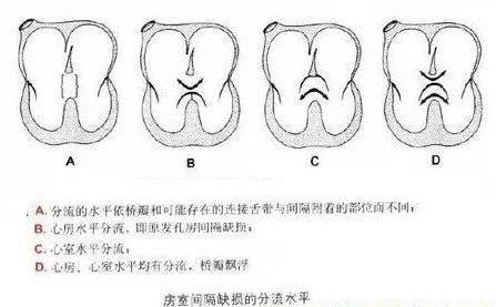 胎儿心内膜垫缺损图片