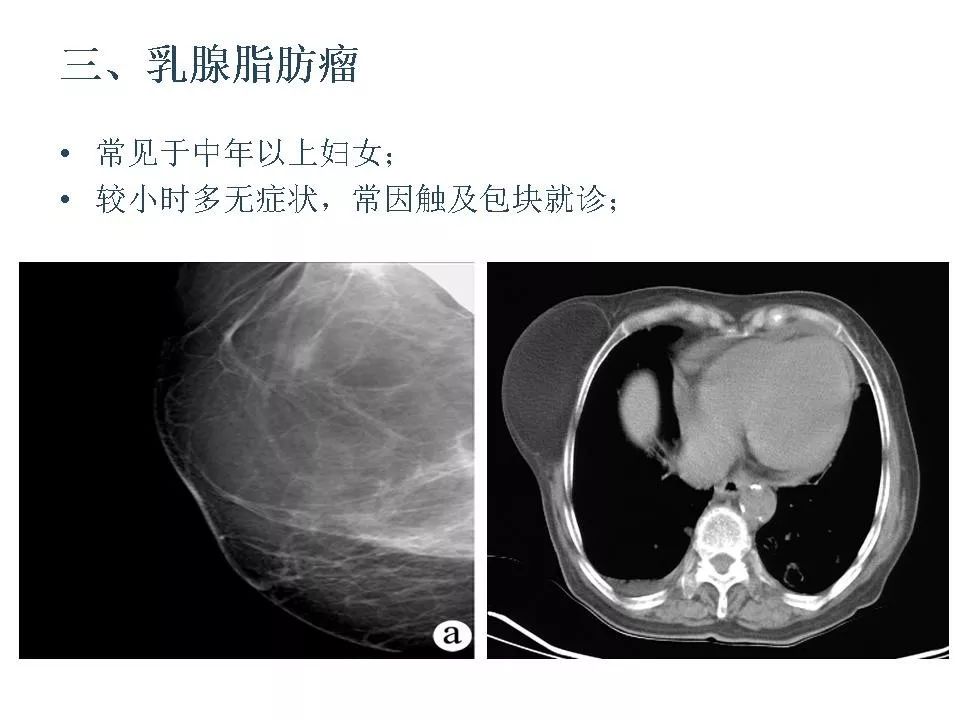 乳腺常见良性肿瘤及肿瘤样病变影像诊断影像天地