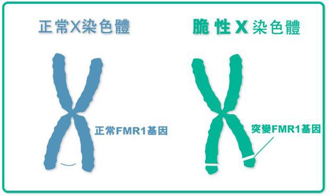 脆性x综合症是什么?怀孕期间要不要做一个脆性x综合症检查?_宝宝
