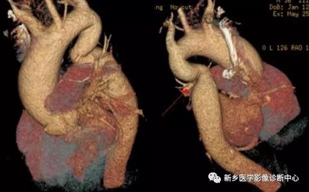 11种主动脉弓部畸形您都了解吗