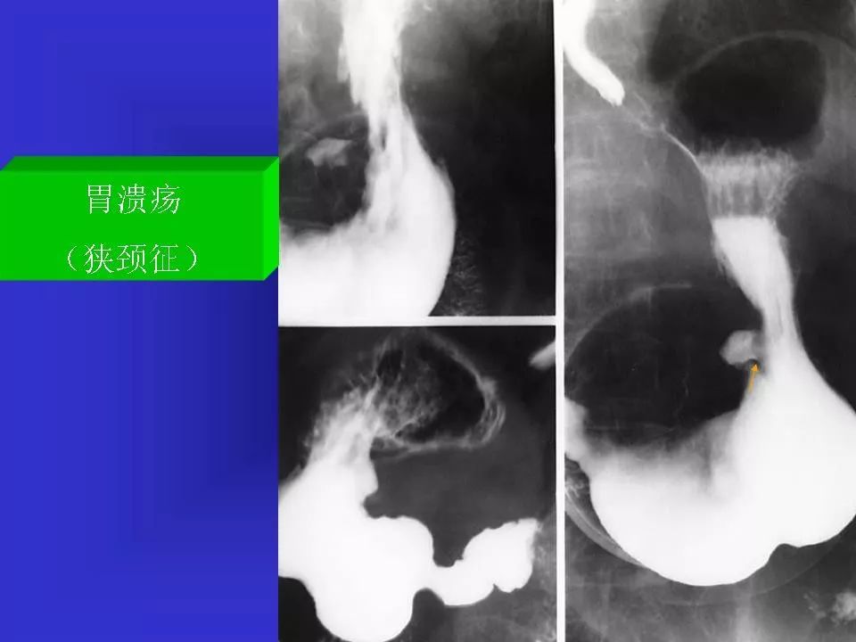 胃溃疡造影图片