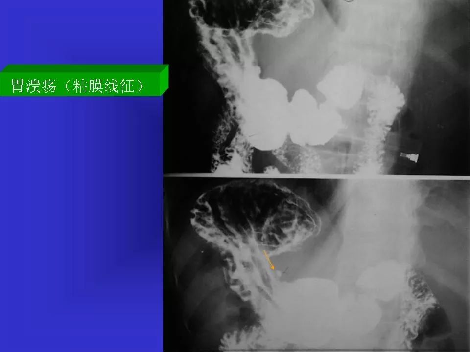 胃溃疡胃癌的影像学表现影像天地