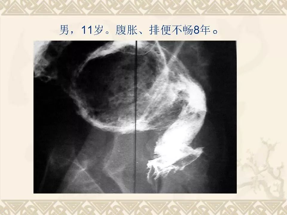 先天性巨结肠的临床与影像学诊断 