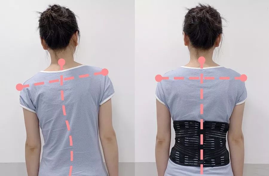 嚴重到身體歪斜左右肩高低不同 戴這款護腰託3個月後 歪斜的腰椎逐漸