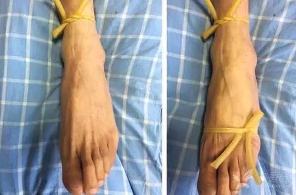 静脉穿刺血管难找扎不上这些方法助你一针见血