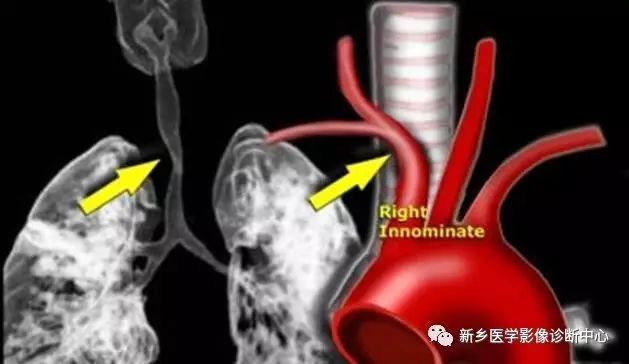 椎動脈起源於主動脈弓十,左右頸總動脈共幹伴迷走右鎖骨下動脈十一