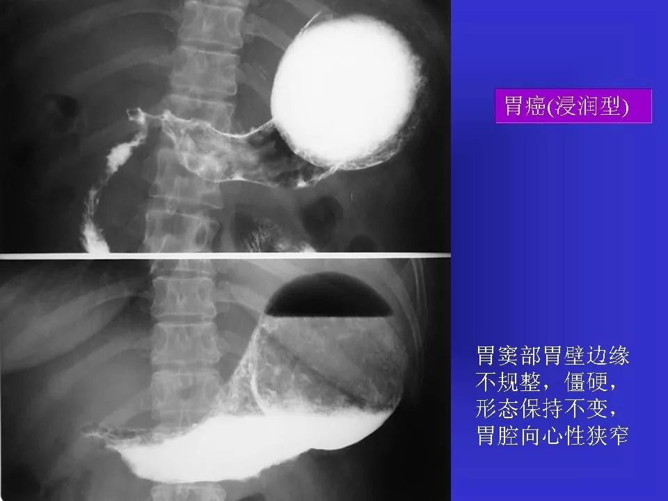 胃溃疡胃癌的影像学表现影像天地