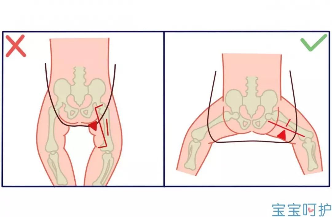 宝宝髋关节不对称图片图片