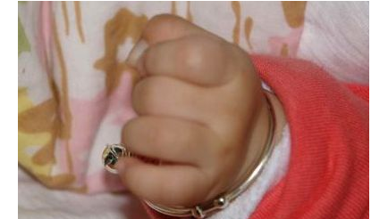 3个月孩子手掌面临截肢,医生取出的东西,宝妈瞬间气的手在抖