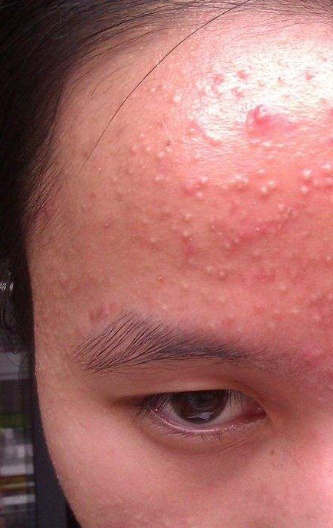 夏季肌肤长痘痘怎么办一定要注意这些事