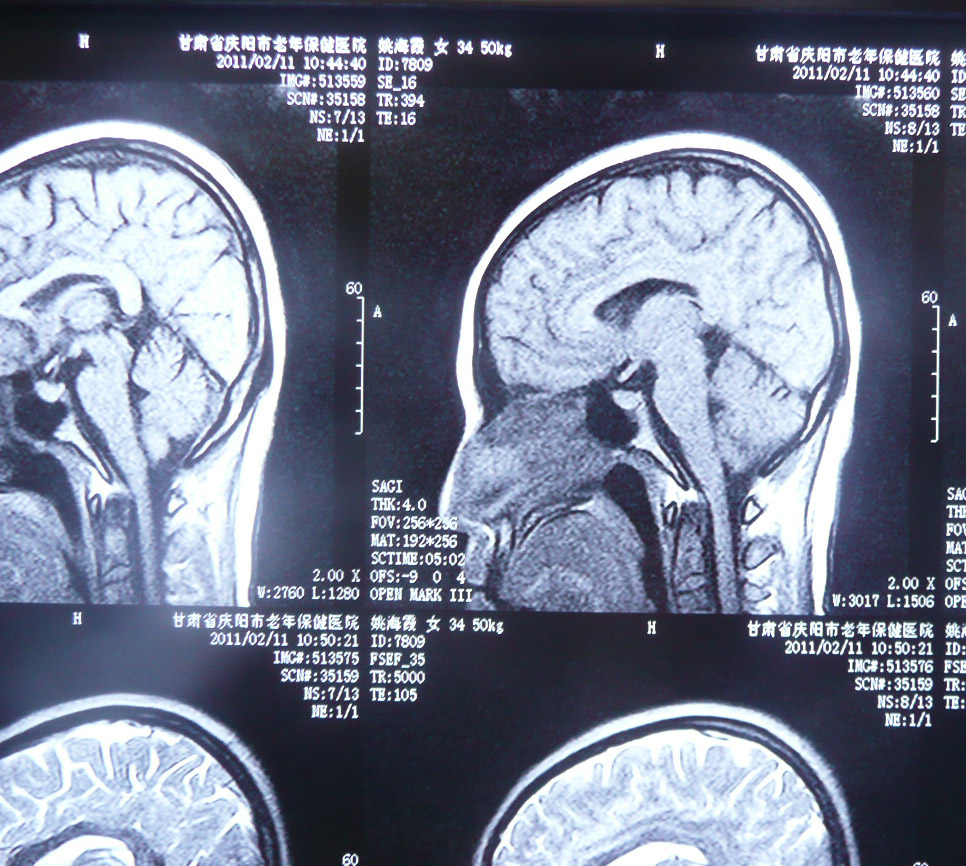 贺晓生教授垂体瘤行伽玛刀治疗有效案例