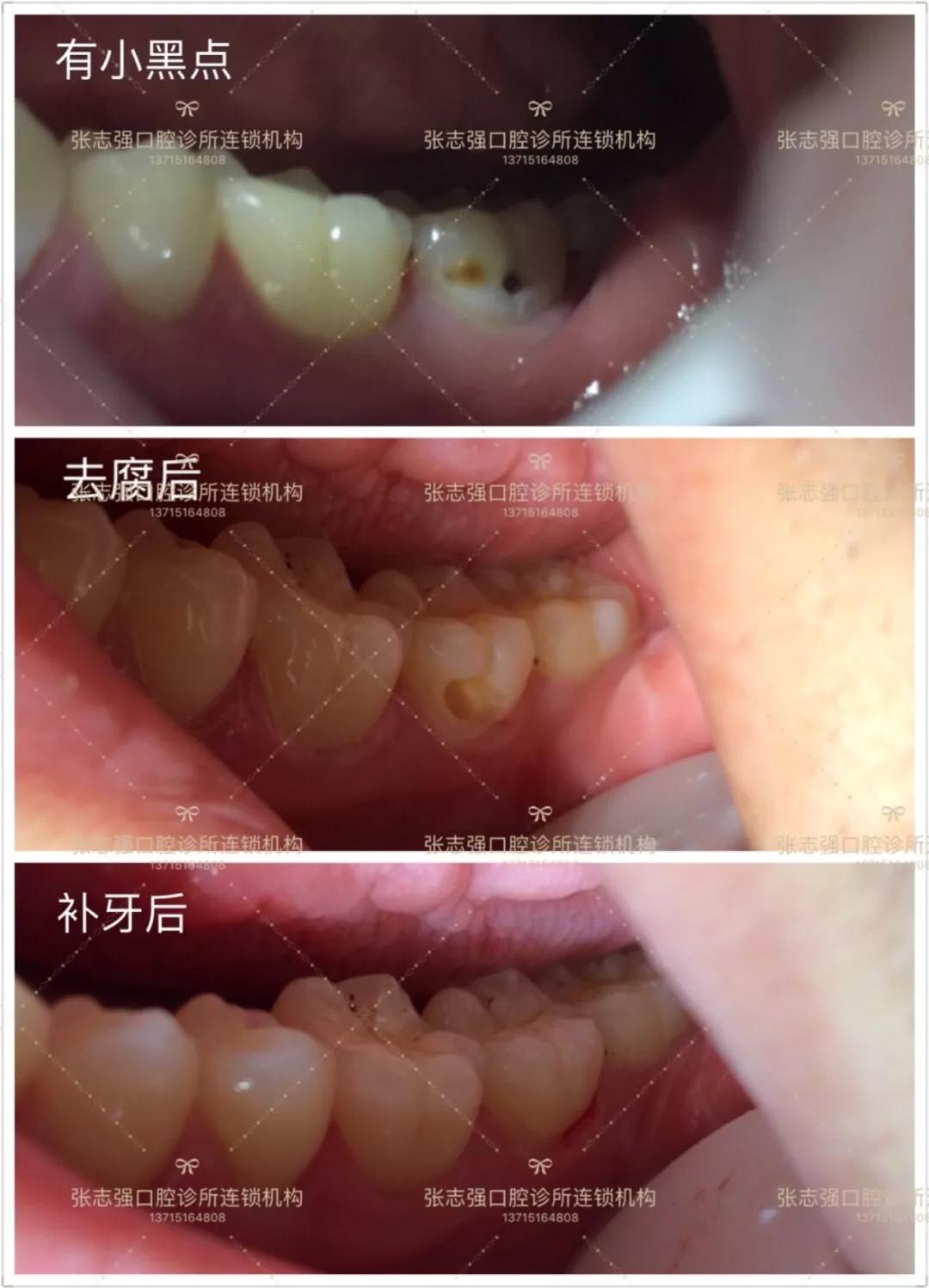 补牙和根管治疗有什么区别