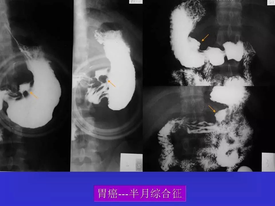 充盈缺损和龛影的区别图片