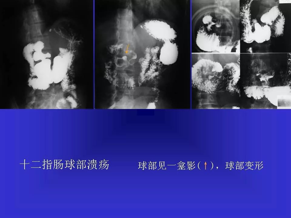 胃溃疡胃癌的影像学表现影像天地