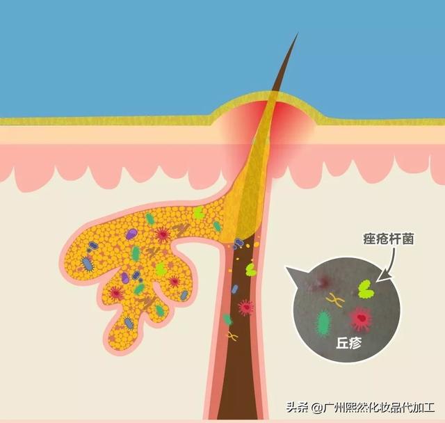 出現粉刺的皮膚受到厭氧菌入侵,厭氧菌在密閉的空間內大量繁殖,刺激