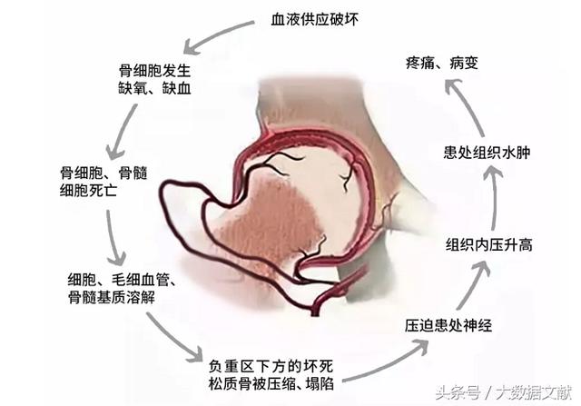 造成股骨头坏死的原因