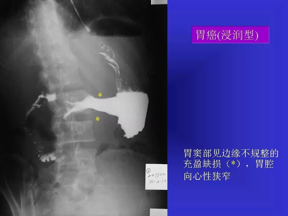 胃溃疡胃癌的影像学表现影像天地