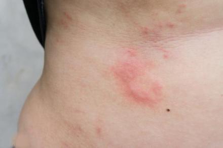 慢性荨麻疹很难根治6个致病原因离远点才会更好