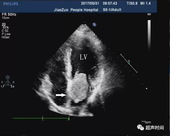 左房黏液瘤有没有哪些知识点是你不知道的