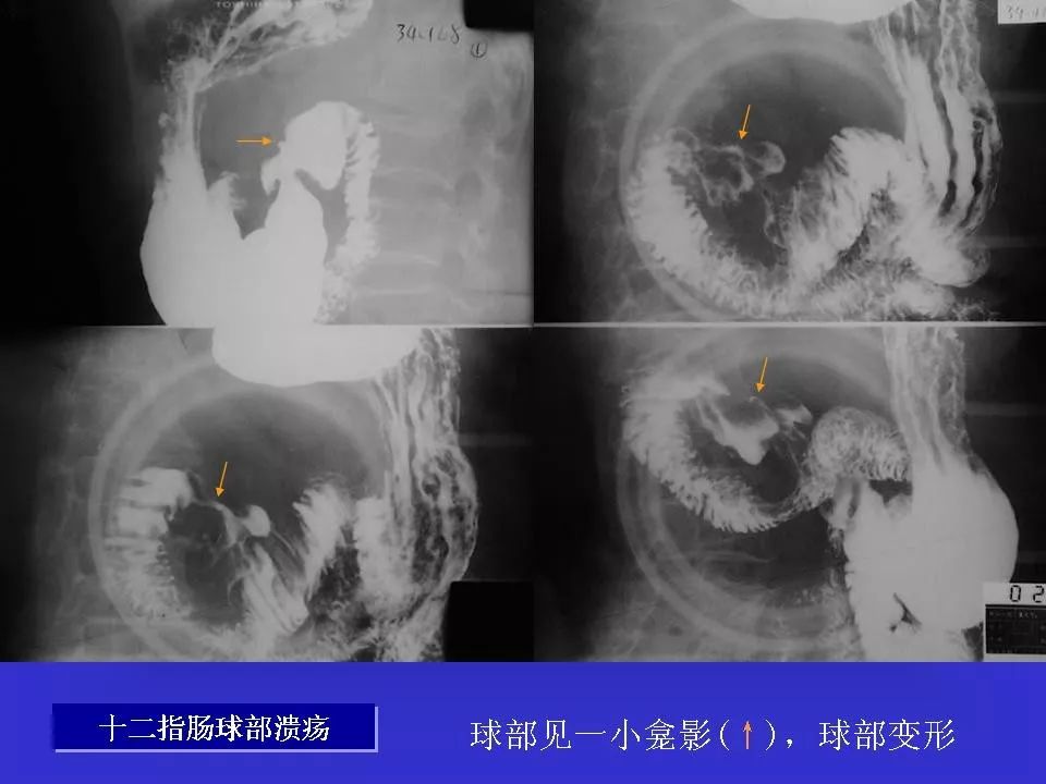 良性龛影与恶性龛影图片