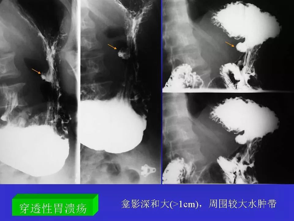 胃溃疡造影图片