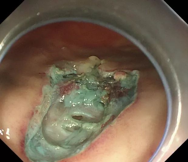 有图有真相 | 消化内镜功能竟如此强大