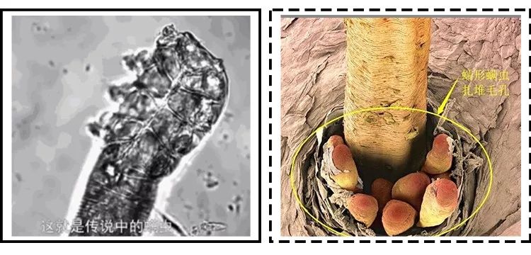 虽然蠕形螨没有致敏性,但它带有针状口器和钩状爪子,在皮肤活动时对