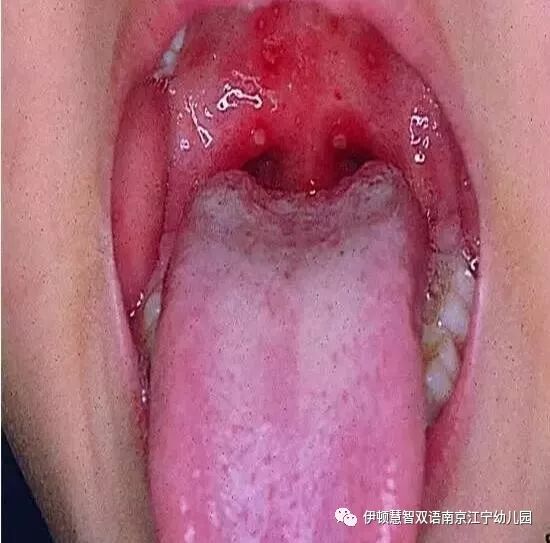 幼儿咽峡炎的症状图片图片