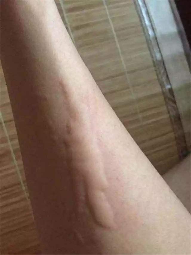 荨麻疹发作病因多这几招轻松治疗风疙瘩