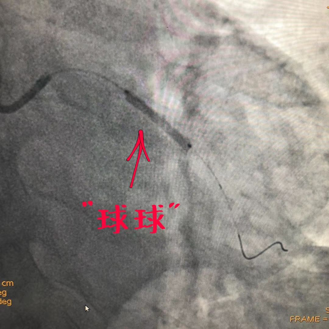 【医技推广】药物球囊治疗冠心病,送给不想植入支架的您_血管