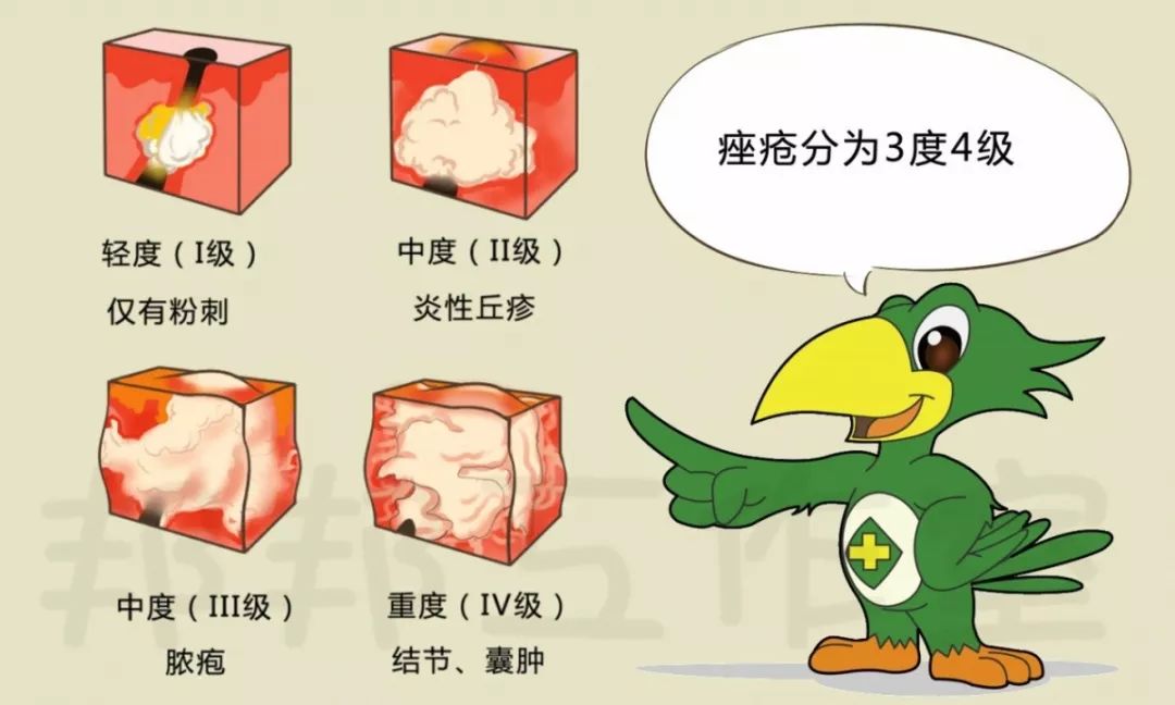 可将痤疮分为三度四级:其中痤疮丙酸杆菌可分解皮脂中的甘油