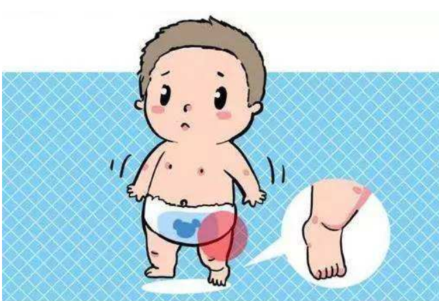 髋关节不牢固的孩子,在出生后很快就能恢复.