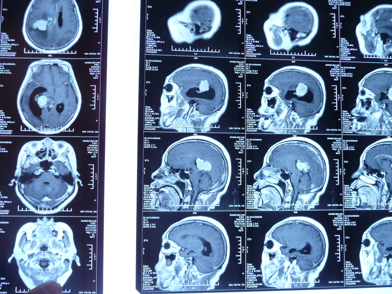 賀曉生教授案例——女性腦膜瘤手術案例