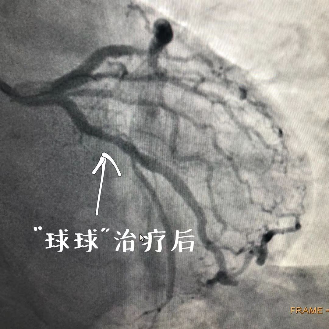医技推广药物球囊治疗冠心病送给不想植入支架的您
