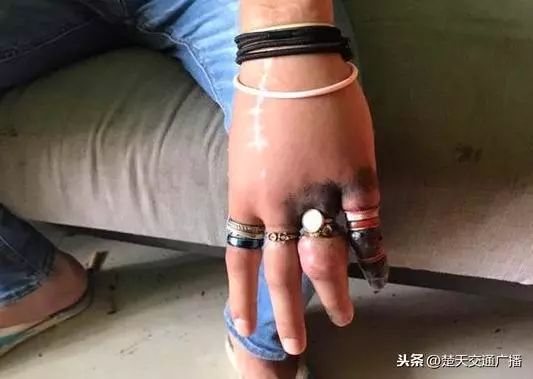 湖北小伙双手戴53枚戒指多根手指肿胀变形