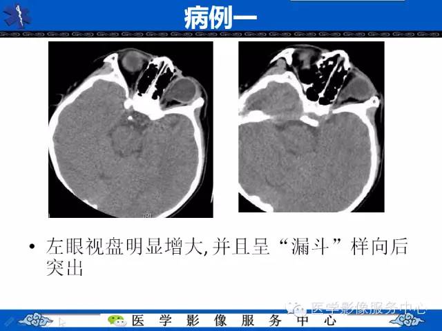 牵牛花综合征的ct和mri诊断
