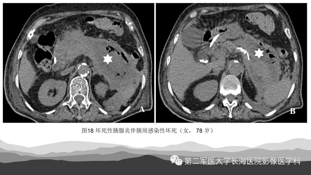 坏死性急性胰腺炎诊断影像治疗