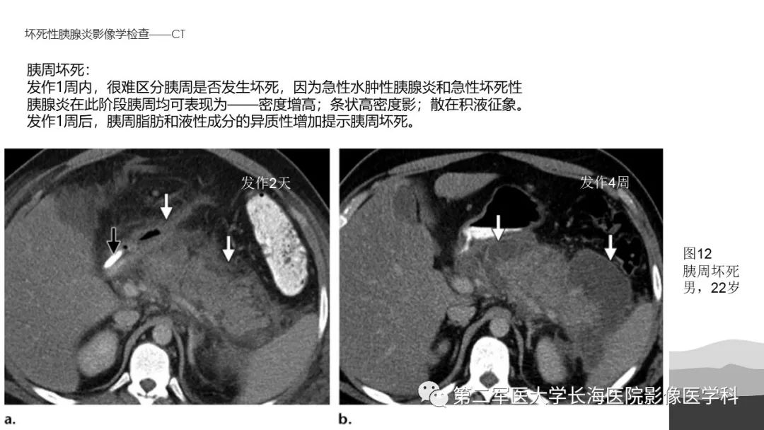 坏死性急性胰腺炎诊断影像治疗